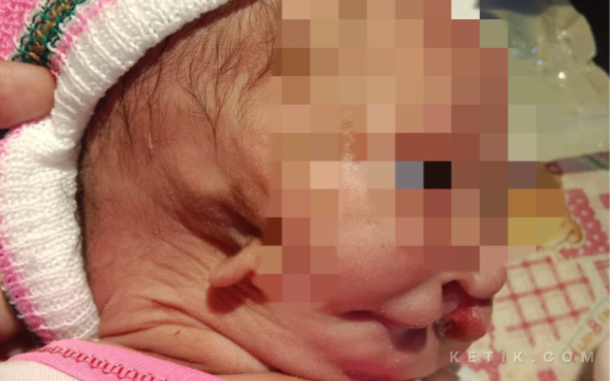 Foto Kelainan bawaan sejak lahir bayi Dewi Andini yang dinilai perlu mendapatkan penanganan kesehatan.  (Foto: Ketik.com)