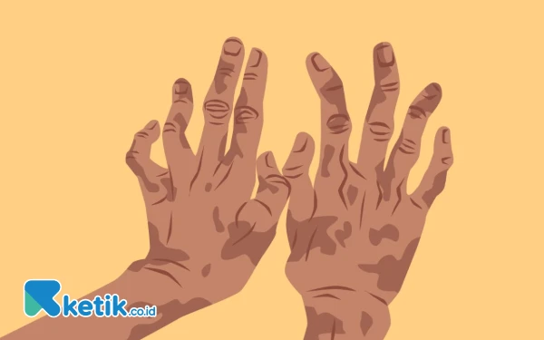 Thumbnail Berita - Indonesia Masih Hadapi Beban Tinggi Penyakit Kusta, Stigma Sosial Picu Keterlambatan Pengobatan