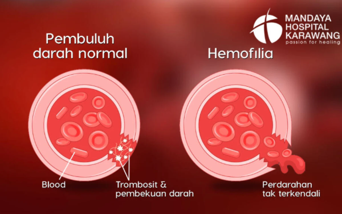 Thumbnail Berita - Banyak Kasus Hemofilia Baru Terungkap Setelah Perdarahan, Dokter Soroti Minimnya Deteksi Dini