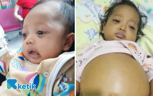 Thumbnail Berita - Perut Terus Membesar, Balita di Teminabuan Sorong Selatan Butuh Uluran Tangan