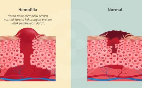 Thumbnail Berita - Mengenal Hemofilia: Penyebab, Jenis dan Bahaya Perdarahan Internal yang Kerap Tak Disadari